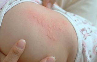 儿童经常见的皮肤病有几种
