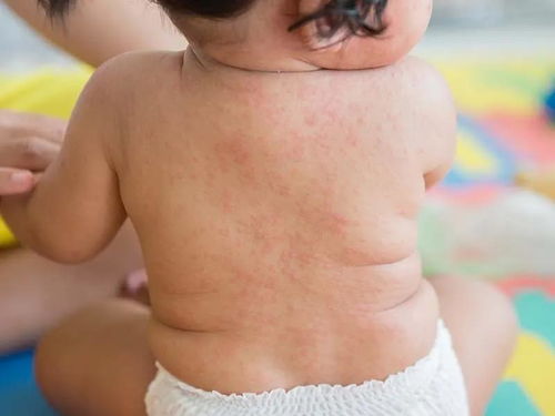 儿童常见皮肤疾病